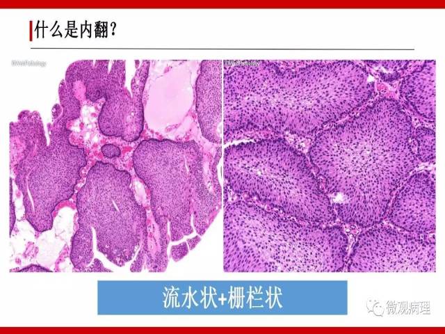 泌尿课程/尿路上皮病变的基本生长方式