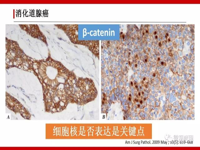 泌尿课程/尿路腺样病变的诊断要点