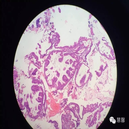 子宫内膜乳头状增生（甜甜分享病例，孔祥田(Max)*Roswell*老师讲解，kent翻译整理文献）