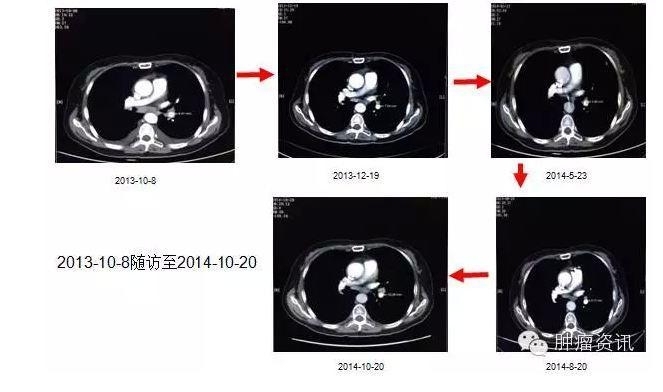 中日韩个体化诊疗案例大赛经典赏析之十——EGFR敏感突变患者，如果TKI原发性耐药，需警惕合并其他驱动基因变异！