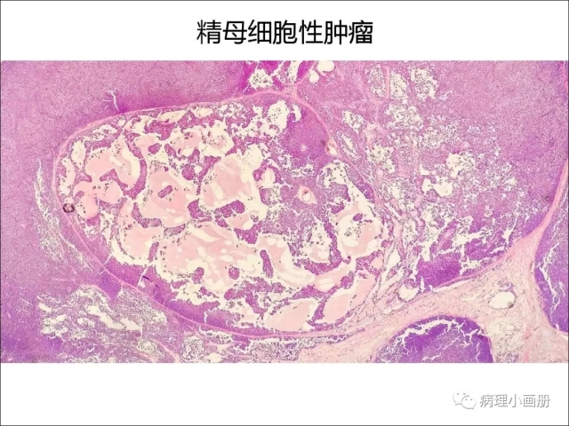 泌尿病理--精原细胞瘤VS精母细胞瘤
