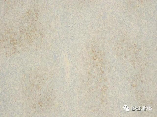 滤泡辅助T细胞（TFH）及其相关淋巴瘤（13）