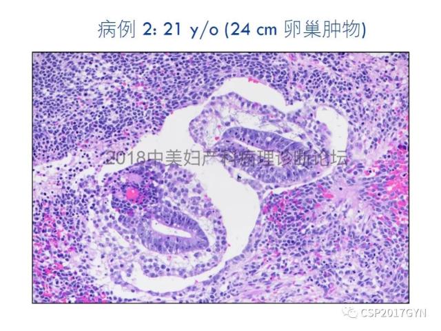 女性生殖道发育