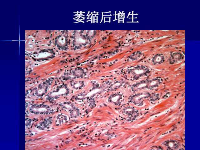 前列腺病理诊断线索（下）——黄教悌