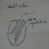 Breast Papillary Les