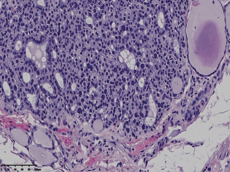 这个甲状腺肿瘤怎么看？