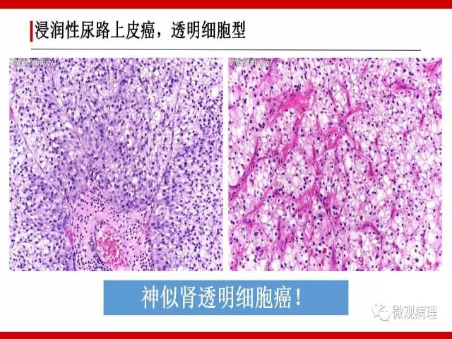 泌尿课程/浸润性尿路上皮癌病理学类型