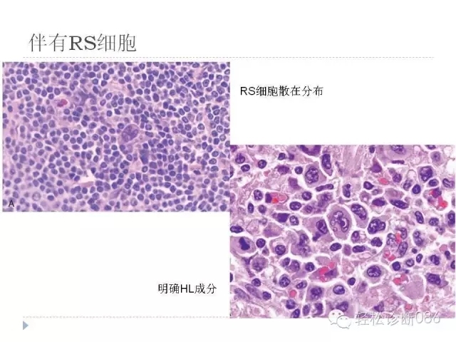 慢性淋巴细胞性白血病