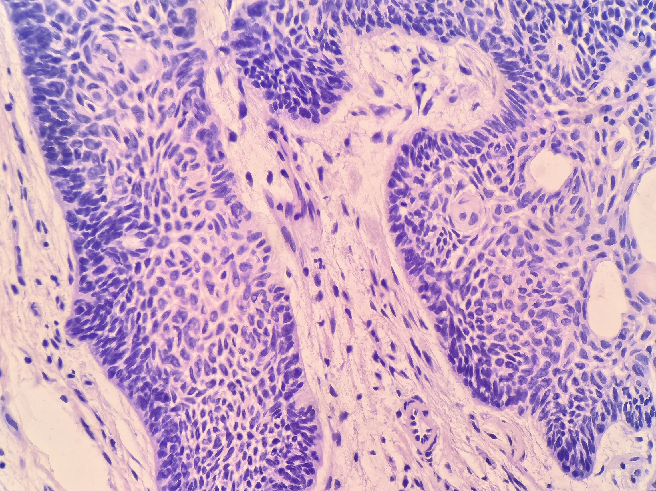 皮肤基底细胞癌伴骨样基质形成一例