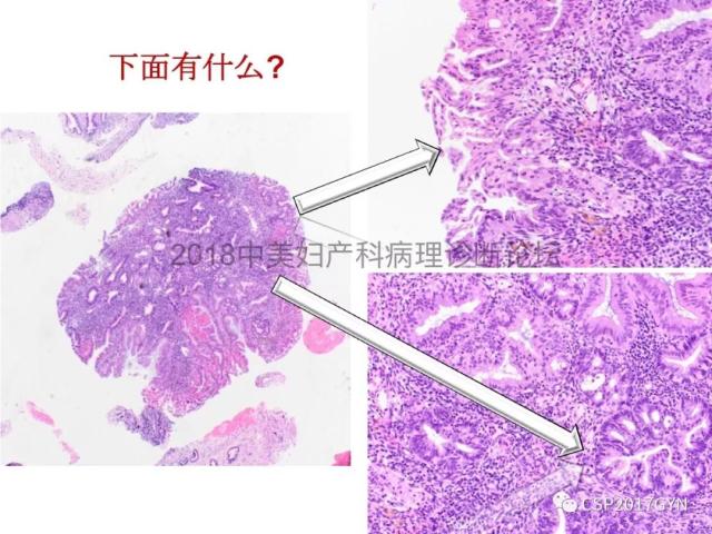 子宫内膜假肿瘤性病变及类似癌样病变