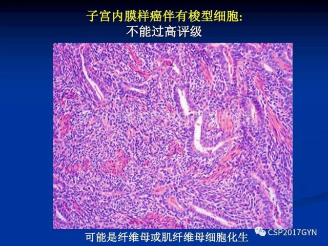 子宫内膜癌：诊断与进展