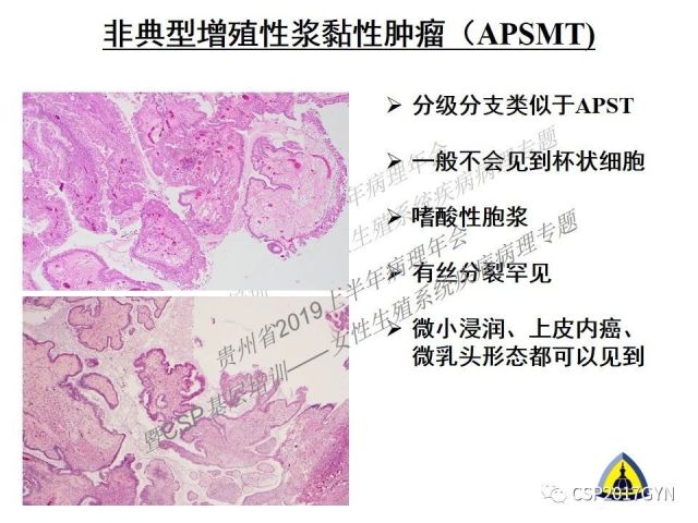 中华病理学会基层培训遵义站讲座（一）——卵巢和输卵管浆液性肿瘤的诊断和鉴别诊断