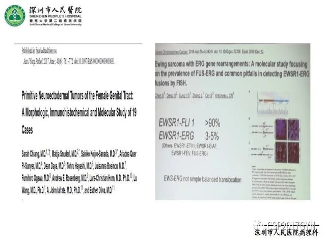2019USCAP妇科病理热点介绍