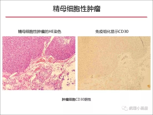 泌尿病理--精原细胞瘤VS精母细胞瘤