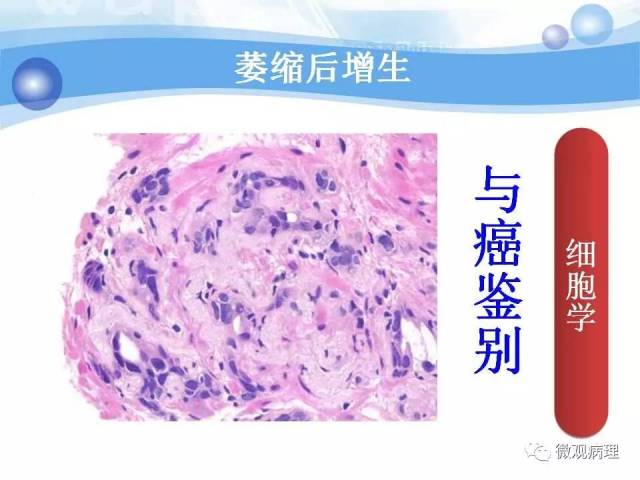 泌尿课程/局灶性前列腺萎缩