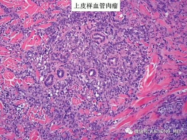 乳腺梭形细胞病变的病理诊断及进展（二）