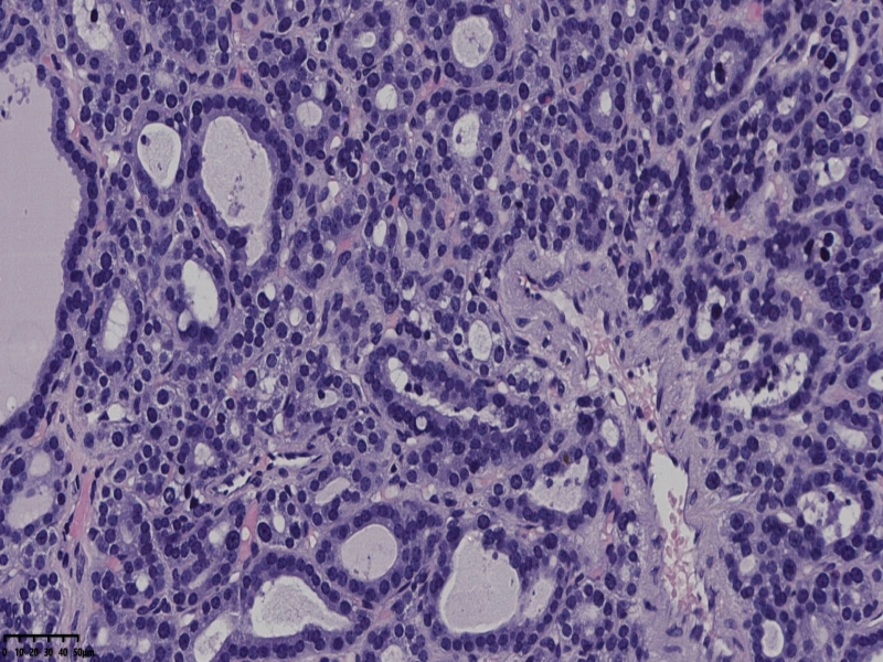 这个甲状腺肿瘤怎么看？