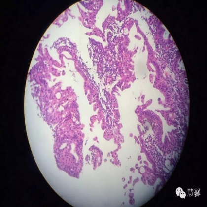 子宫内膜乳头状增生（甜甜分享病例，孔祥田(Max)*Roswell*老师讲解，kent翻译整理文献）