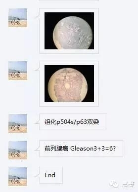 前列腺TURP的取材、偶发前列腺癌的报告、分期方法浅说（张睿病例分享，孔祥田(Max)*Roswell*NM老师讲解）