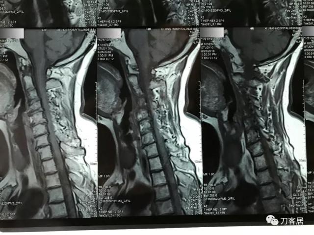 医生及患者通用:如何用手机翻拍X线片,磁共振片子,CT片子进行网络求医、病例讨论及保留资料 医生及患者通用:如何用手机翻拍X线片,磁共振片子,CT片子进行网络求医、病例讨论及保留资料