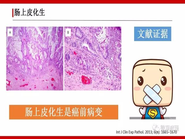 泌尿课程/尿路腺样病变的诊断要点