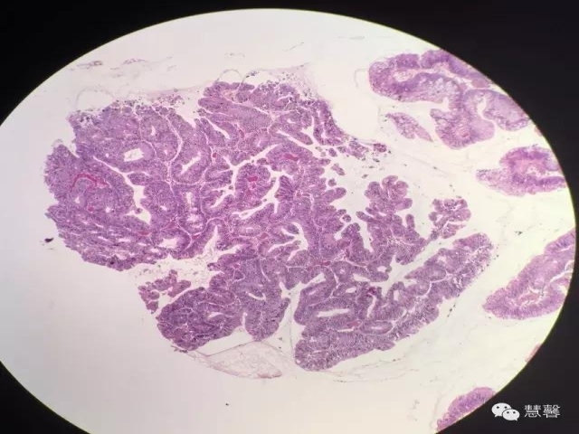 结、直肠管绒毛状腺瘤-高级别病变取材、诊断及报告相关问题（悄悄分享、掌心及孔祥田(Max)*Roswell*NM老师讲解）