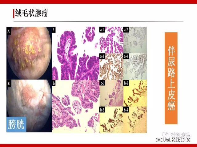 泌尿课程/尿路腺样病变的诊断要点