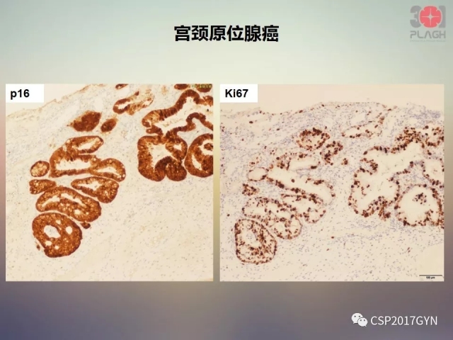 宫颈腺癌的临床病理研究进展