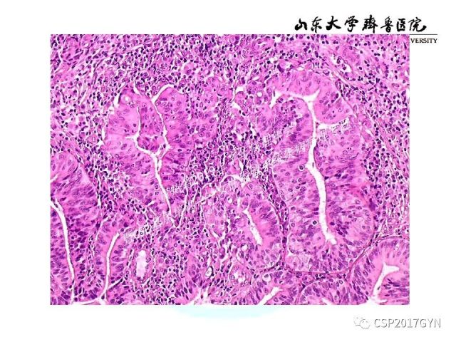 中华病理学会基层培训遵义站讲座（四）——宫颈腺癌的诊断及新分型