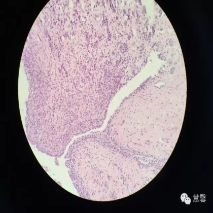 High grade nested variant Urothelial carcinoma(老胡分享，孔祥田老师讲解)