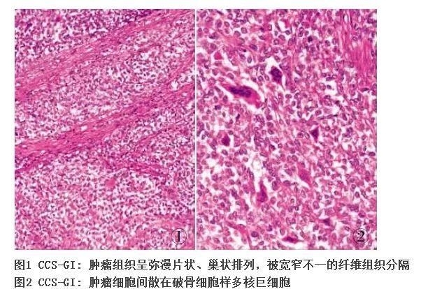 新近认识的胃肠道间叶性肿瘤