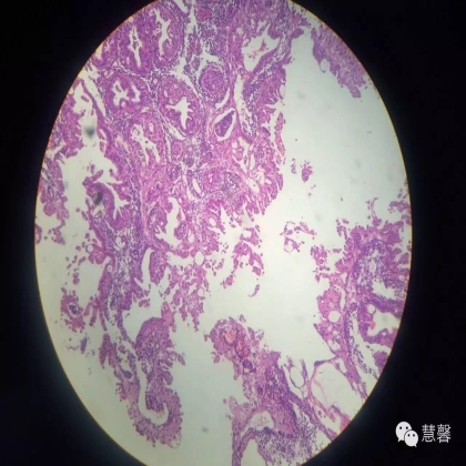 子宫内膜乳头状增生（甜甜分享病例，孔祥田(Max)*Roswell*老师讲解，kent翻译整理文献）