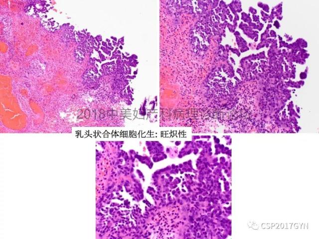 子宫内膜假肿瘤性病变及类似癌样病变