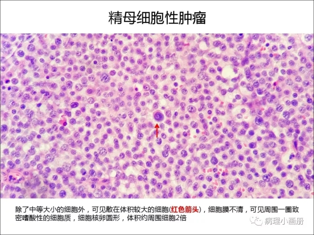 泌尿病理--精原细胞瘤VS精母细胞瘤