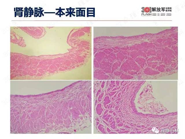 泌尿系统常见肿瘤标本病理报告规范