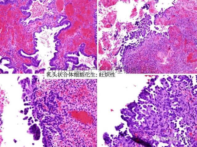 子宫内膜假肿瘤性病变及类似癌样病变