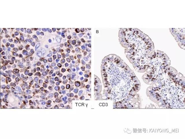 T细胞淋巴瘤病理诊断及进展（三）