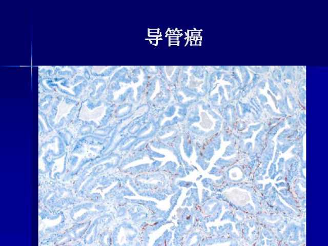 前列腺病理诊断线索（上）——黄教悌