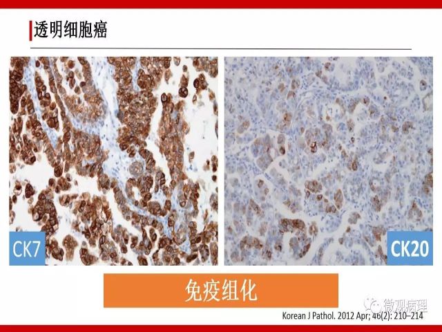 泌尿课程/尿路腺样病变的诊断要点