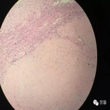 High grade nested variant Urothelial carcinoma(老胡分享，孔祥田老师讲解)