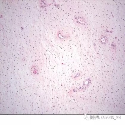 女性生殖道软组织肿瘤病理诊断及进展（二）