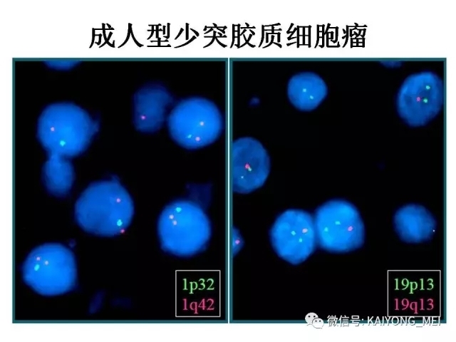 2016 WHO中枢神经系统肿瘤分类解读（二）