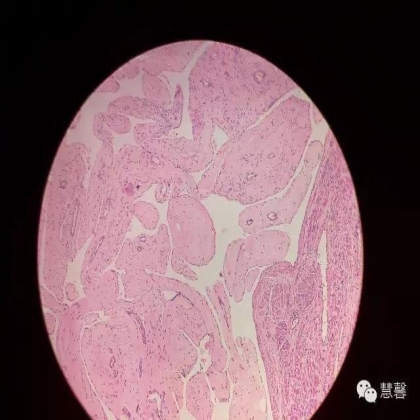 子宫血管内平滑肌瘤（香溪鲟分享，孔祥田(Max)*Roswell*老师讲解）