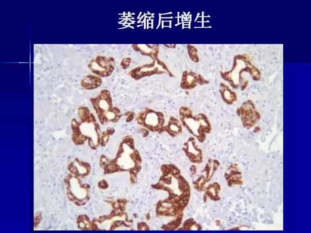 前列腺病理诊断线索（下）——黄教悌