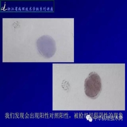 《常规免疫组化初筛ALK阳性非小细胞肺癌专家共识》技术部分解读