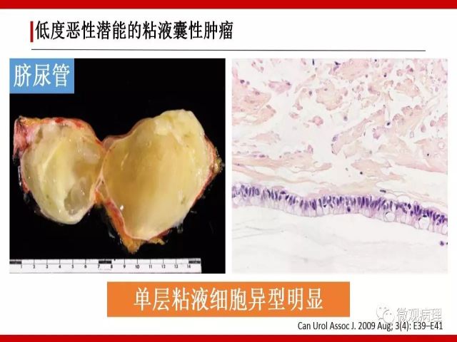 泌尿课程/尿路腺样病变的诊断要点