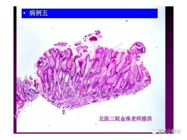 上消化道早癌病理的学习心得体会（附胃牵手癌的病例特点文献学习）