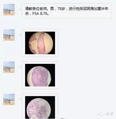 前列腺TURP的取材、偶发前列腺癌的报告、分期方法浅说（张睿病例分享，孔祥田(Max)*Roswell*NM老师讲解）