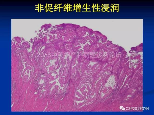 子宫内膜癌：诊断与进展