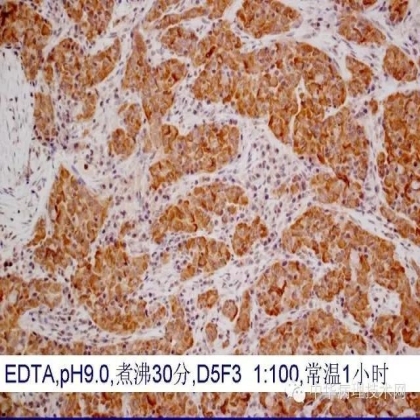 《常规免疫组化初筛ALK阳性非小细胞肺癌专家共识》技术部分解读